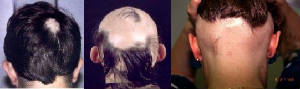 verschillende stadia van alopecia areata